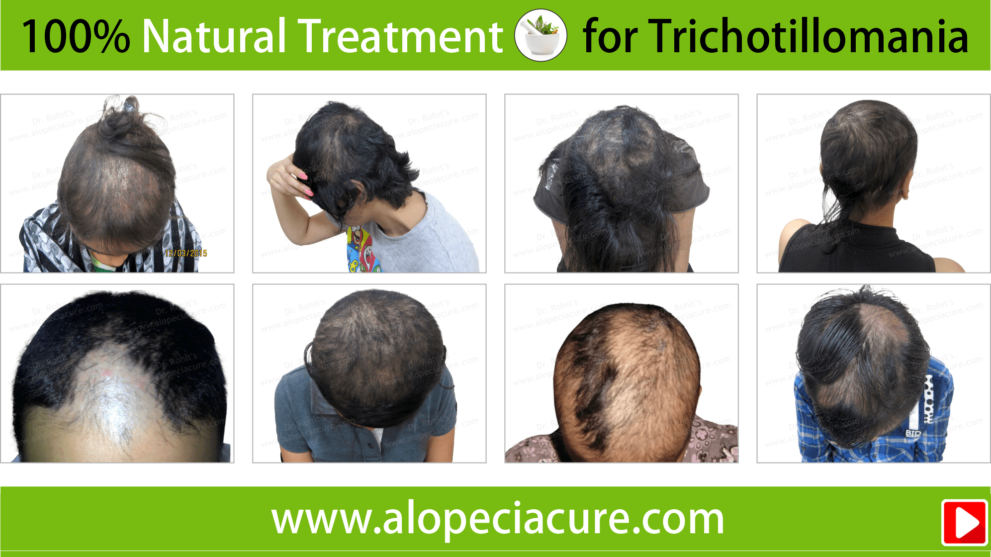 trichotillomania treatment